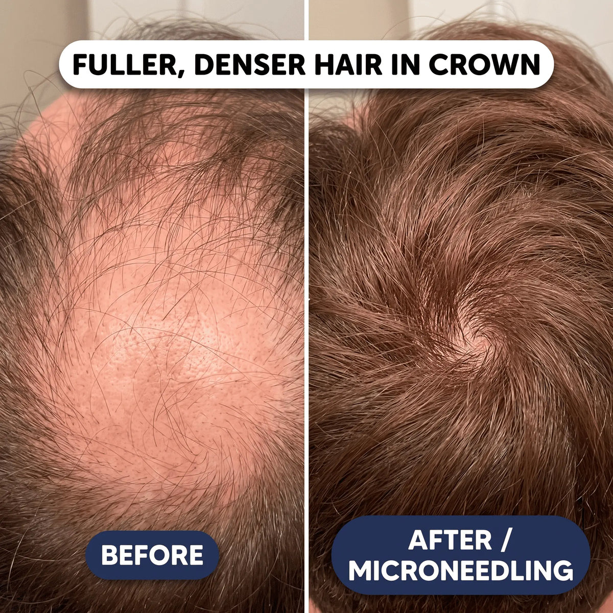 Peptide Infusion Hair Regrowth System