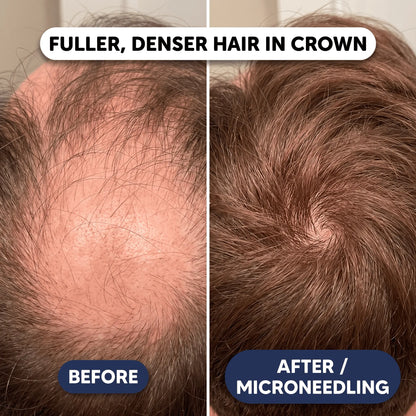 Peptide Infusion Hair Regrowth System